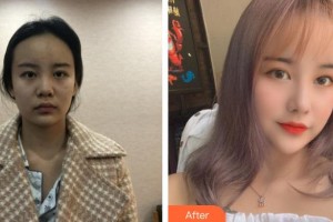 太原華美整形美容醫(yī)院于智宏整形價格表附鼻部綜合案例展示