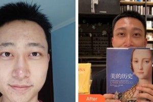 太原顯微手外科醫(yī)院毛發(fā)移植中心謝祥整形價格表附種眉毛案例展示