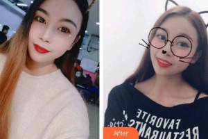 太原歐美蓮整形美容醫(yī)院高惠園整形價格表附鼻部綜合案例展示