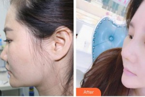 太原歐美蓮整形美容醫(yī)院樸光仁整形價格表附鼻部綜合案例展示