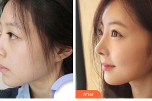 太原時光整形美容醫(yī)院路衛(wèi)國整形價格表附假體隆鼻案例展示