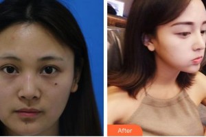 太原青松醫(yī)療美容門診部金漢祚整形價格表附硅膠隆鼻案例展示