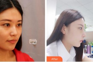 太原美萊整形醫(yī)院金大原整形價格表附光子嫩膚案例展示