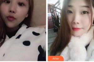 太原華美整形美容醫(yī)院鞏慧珍整形價格表附自鎖托槽矯正案例展示