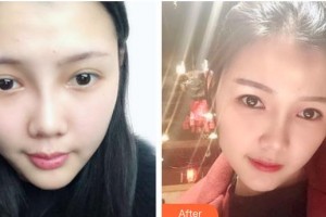 太原塑美美容整形門診部樊婭娜整形價格表附鼻部綜合案例展示