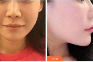 太原晉容整形美容門診部王雅爾整形價格表附埋線提升案例展示