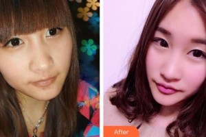 太原長城醫(yī)院整形美容中心郭霞整形價格表附埋線提升案例展示