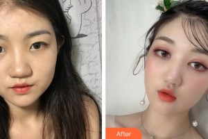 桂林華美醫(yī)療美容門診部游海鋒整形價格表附雙眼皮手術案例展示