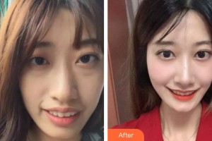 貴陽利美康醫(yī)院張萍整形價(jià)格表附牙齒矯正案例展示