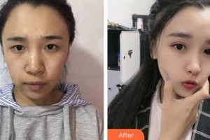 太原晉綺醫(yī)療美容診所顏崇文整形價格表附眼部綜合案例展示