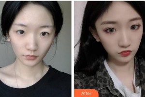 太原星范醫(yī)療美容門診部張金輝整形價格表附切開雙眼皮案例展示