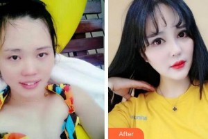 太原美媛薈整形美容醫(yī)院弓軍勝整形價(jià)格表附眼部綜合案例展示