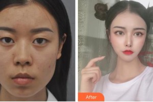 太原美媛薈整形美容醫(yī)院陳霆璋整形價(jià)格表附埋線提升案例展示