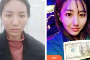太原美媛薈整形美容醫(yī)院李燕整形價(jià)格表附埋線提升案例展示