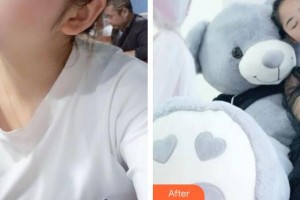 太原華美整形美容醫(yī)院李霞整形價(jià)格表附埋線提升案例展示