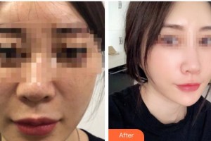 太原星范醫(yī)療美容門診部魏星整形價(jià)格表附埋線提升案例展示