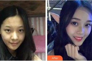 太原歐美蓮整形美容醫(yī)院曾繁聞?wù)蝺r(jià)格表附埋線提升案例展示