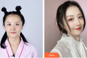 貴陽(yáng)中醫(yī)皮膚病醫(yī)院植發(fā)中心張芳勇整形價(jià)格表附植發(fā)案例展示