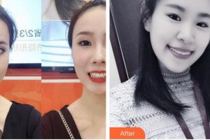 太原晉綺醫(yī)療美容診所洪欣瑜整形價(jià)格表附下瞼整形案例展示