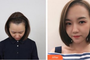 太原顯微手外科醫(yī)院毛發(fā)移植中心王亞麗整形價(jià)格表附美人尖種植案例展示