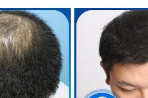 太原時光整形美容醫(yī)院邸紅亮整形價格表附頭頂加密種植案例展示