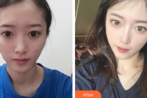 太原軍大醫(yī)療美容醫(yī)院王紅梅整形價格表附埋線提升案例展示