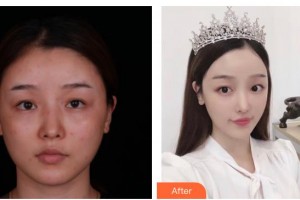 太原軍大醫(yī)療美容醫(yī)院楊祥勝整形價格表附鼻部綜合案例展示