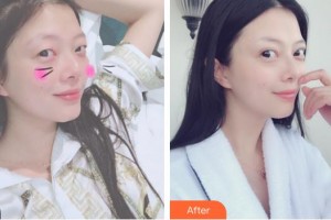 太原愛爾眼科醫(yī)院李晉華整形價(jià)格表附切開雙眼皮案例展示