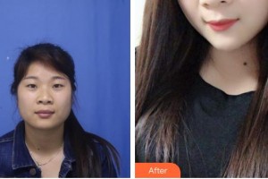 太原華美整形美容醫(yī)院張鵬云整形價格表附定點雙眼皮案例展示