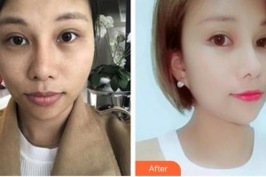 太原愛爾眼科醫(yī)院劉新榮整形價(jià)格表附眼部綜合案例展示