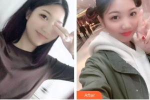 太原恒倫口腔醫(yī)院馬國華整形價格表附根管調節(jié)案例展示