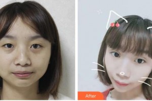 太原時(shí)光整形美容醫(yī)院席曉云整形價(jià)格表附埋線提升案例展示