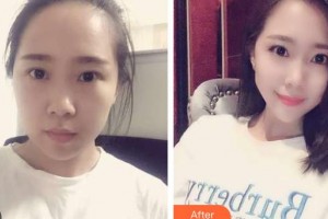 太原星范醫(yī)療美容門診部李凱整形價(jià)格表附切開雙眼皮案例展示