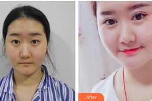 太原星范醫(yī)療美容門診部徐凱整形價格表附眼部綜合案例展示