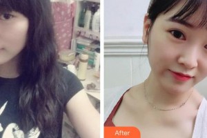 大同解放軍322醫(yī)院醫(yī)學(xué)整形美容中心朱清海整形價格表附切開雙眼皮案例展示