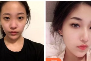 大同美神整形美容醫(yī)院王賀宇整形價格表附鼻部綜合案例展示