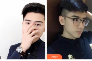 大同鳳凰婦產(chǎn)醫(yī)院整形美容科張昕整形價格表附鼻部綜合案例展示