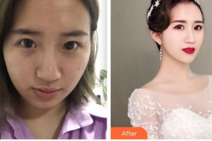 大同清木整形醫(yī)院張樹霞整形價格表附埋線提升案例展示