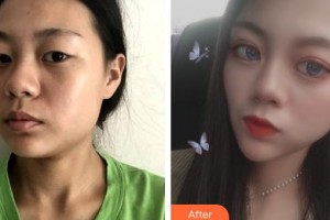 大同市第五人民醫(yī)院乳腺整形科睢瑞和整形價格表附埋線提升案例展示