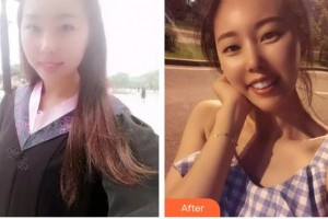 大同清木整形醫(yī)院趙榮整形價格表附埋線提升案例展示