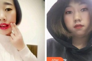 大同美神整形美容醫(yī)院王東整形價格表附根管調節(jié)案例展示