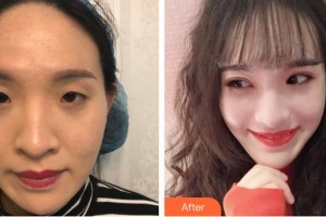 大同清木整形醫(yī)院朱東磊整形價格表附眼部綜合案例展示