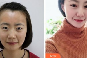 大同清木整形醫(yī)院李楠整形價格表附切開雙眼皮案例展示