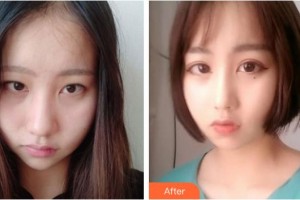 陽泉美亞醫(yī)療美容診所劉鶯燕整形價(jià)格表附鼻部綜合案例展示