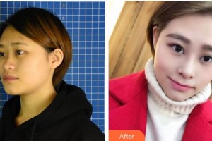 陽泉美亞醫(yī)療美容診所李茹英整形價(jià)格表附鼻部綜合案例展示