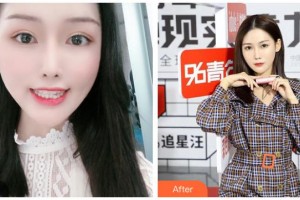 長治億大口腔醫(yī)院趙香萍整形價(jià)格表附隱形托槽矯正案例展示