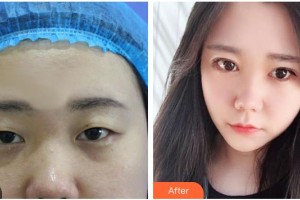 長(zhǎng)治天成醫(yī)療美容診所郭妍整形價(jià)格表附定點(diǎn)雙眼皮案例展示