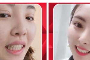 長治億大口腔醫(yī)院張睿整形價(jià)格表附牙齒隱形矯正案例展示