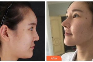 晉城市眼科醫(yī)院張進(jìn)軍整形價格表附切開雙眼皮案例展示