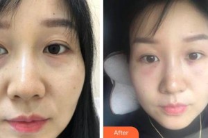 晉城市眼科醫(yī)院尚利霞整形價(jià)格表附激光去眼袋案例展示